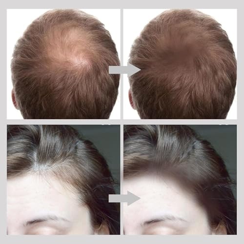 Image of Hairline Powder Stick for Women & Men, Natural Shadow Filler & Shading Sponge Pen for Thinning Hair, Quick Root Touch-Up & Hairline Concealer (BROWN HAIR STICK POWDER)