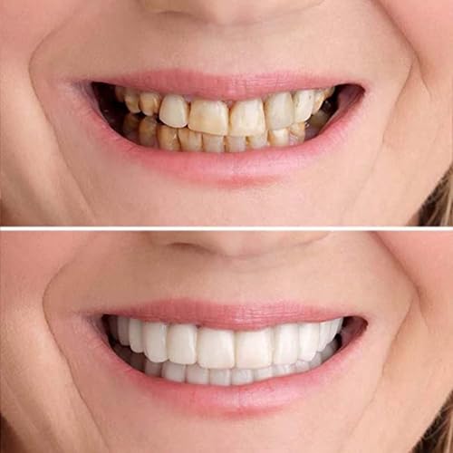 Image of 2 PCS, Temporarily Adjustable, Nature and Comfortable,Beautiful Smile