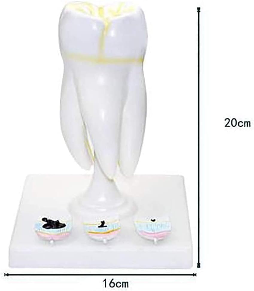 ERNZI Modèle Dentaire, Démonstration Biomédicale Enseignement De Anatomie des Dents Humaines, Modèle De Carie Dentaire Molaire, Modèle Enseignement Standard pour Adultes