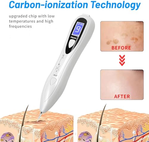 Image of Mole Removal Laser Pen, Plasma Pen, Portable Wart Remover for Skin Tag, Freckle and Spot Removal Mlticolour