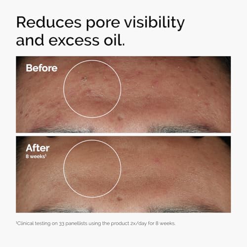 Image of The Ordinary Niacinamide 10% + Zinc 1%, Smoothing Serum for Blemish-Prone Skin