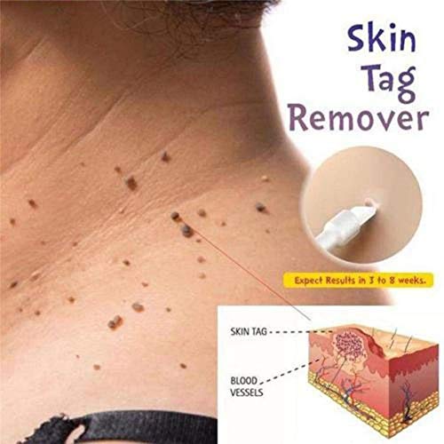 mole and skin tag remover