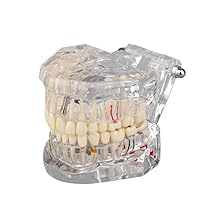 Ultrassist Transparent Dental Disease Teeth Model with Removable Teeth, Dental Pathology Demonstration Model for Dentist Patient Education & Teaching