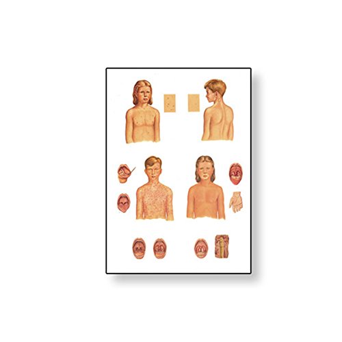 3B Scientific V2070M Infectious Childhood Diseases Wall Chart 84x118 cm,Grade: 2" Height, 2" Wide, 35" Length