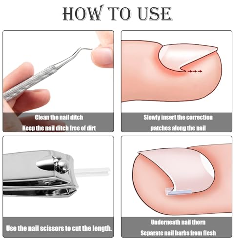 Image of 102pcs Ingrown Toe Nail Remover, Toenail Corrector Strips and Ingrown Toenail Correction Tool, for Daily Nail Care and Post-Exercise Maintenance,