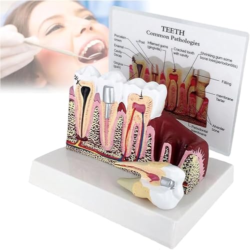 Tooth Model, Dental Caries Tooth Model,Teeth Cross-Section Model Gums Model Anatomy Teeth Model Detachable Education Dental Model for Students