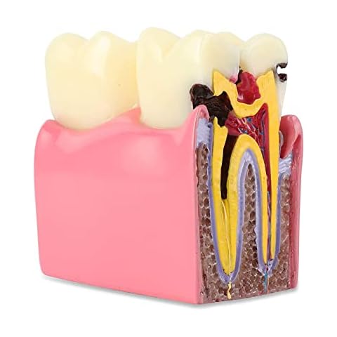 Professional Teeth Model, 6 Times Caries Contrast Dental Model Cover