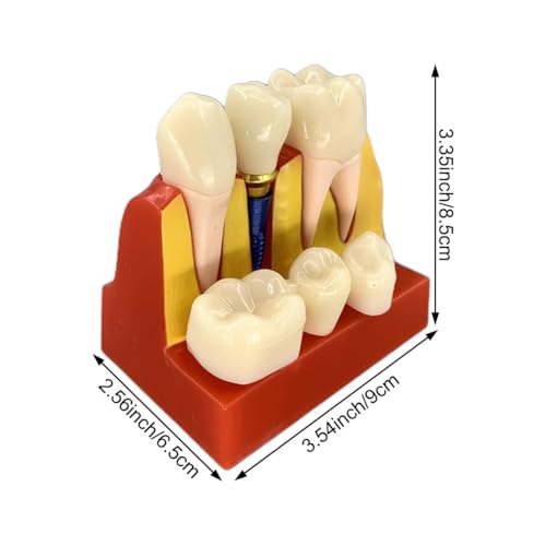 Modelo de dientes con demostración de puente y análisis de implante dental 3