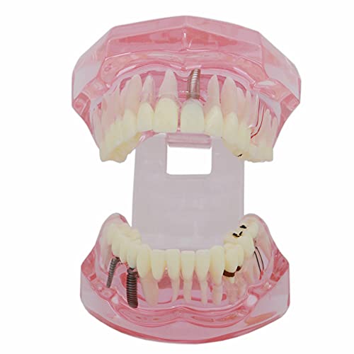 Dentalmall Teeth Model Teeth Typodonts Dental Implant Study Analysis Demonstration Teeth Model #2001 With Restoration Pink #TOP3