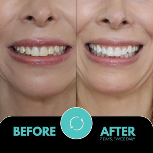 Image of IntelliWHiTE ProStrips Teeth Whitening Strips, 14 Day Treatment, Whitens Up to 12 Shades, Enamel-Safe Gentle Remineralizing Formula, Dentist Formulated for Sensitive Teeth, (28pk Coconut Flavor)