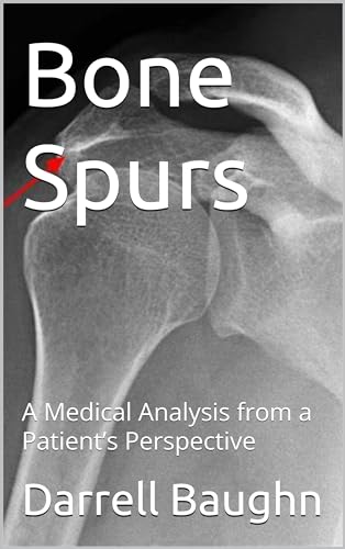 Bone Spurs: A Medical Analysis from a Patient’s Perspective