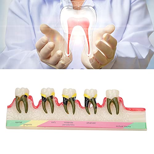 Teeth Model, Dental Orthodontic Model Dental Periodontal Disease Model for Dental School Tooth Teeth Study Teaching Model Dental Implant Model Tooth Disease Study Teaching Model