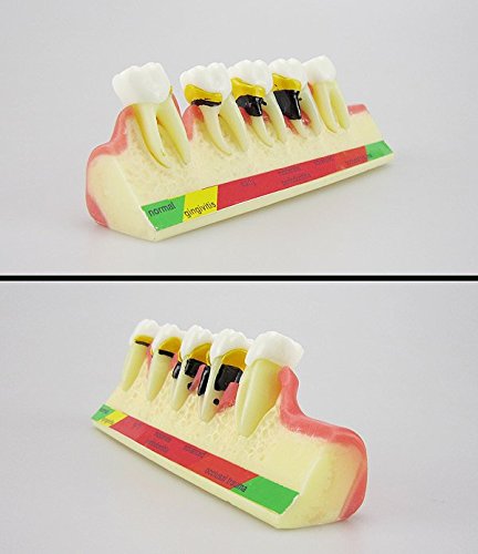 La maladie parodontale dentaire prématurée associe le modèle pédagogique des études sur les dents de dents Typodont