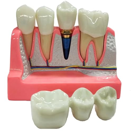 Rwbatt DM625 4 Times Dental Implant Model With Removable Crown Bridge Dental Veneers Porcelain Teeth thumb #6
