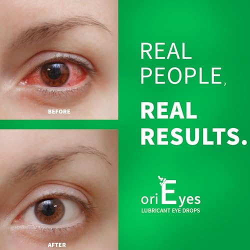 DriEyes Redness Reliever Eye Drops for brighter looking eyes | 0.5 Fl Oz (15 mL) | Eye Allergy Relief | Quick Acting | S