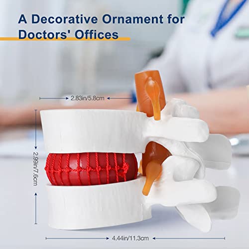Image of Healthible Human Lumbar Disc Herniation Demonstration Model - Anatomical Lumbar Vertebral Model Disc Herniation Modelfor Education and Study