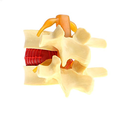 menolana — Ampliação de exibição de protrusão de disco lombar humano anatômico