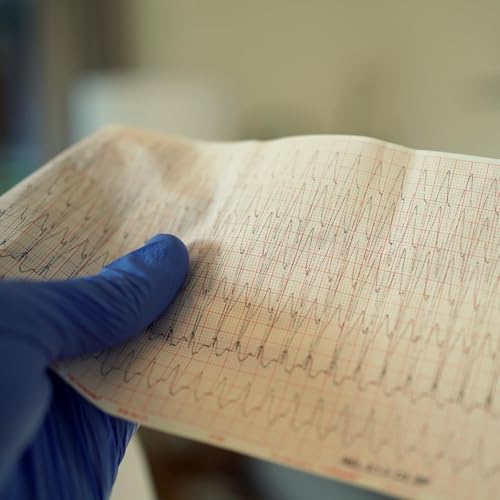Wide Complex Tachycardia