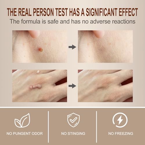 Image of Wart Cream Fast Acting Gel Wart Remover Freeze Off-Fast-Acting Wart's Ointment,genital warts Remover,Foot Warts Corn Removal for Feet Hands for Plantar , Flat , Common , Corn, H Warts, Callus-AAR222