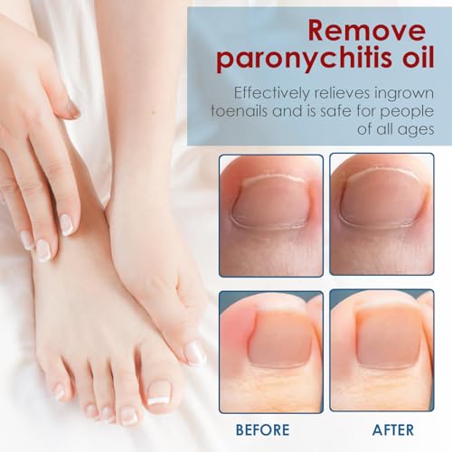 10ml Nagelaufbauserum,Nagelpflege,Nagelaufbauserum,Effektiver Nagellack,Nagelpflege pflegend,NägelReparatur für pflegt rissige,Nagelpflege für Fuß & Hand