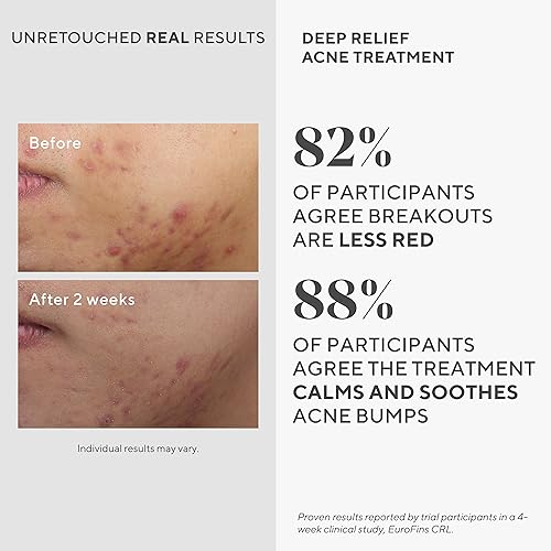 image for Murad Deep Relief Acne Treatment - Maximum Strength Acne Treatment wit