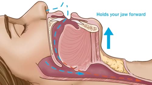 Dentemp Sleeptight Mouthpiece – Anti Snoring Devices Custom Fit Mouthguard For A Better Night’s Sleep - Designed By A Dentist And Made In Usa #TOP3