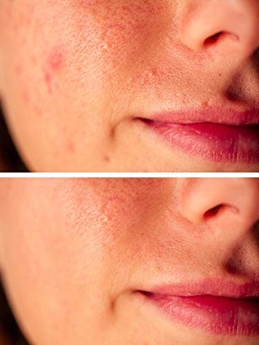 image for DrFormulas Dermtella Clear Skin Support Packs | Pills with Zinc, Probi
