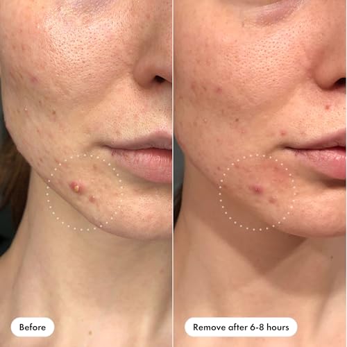 Mighty Patch™ Invisible+ Patch – The Barely-There Daytime Hydrocolloid Acne Pimple Patch for Covering Zits and Blemishes, Tapered Edges Designed to Blend Into Skin (72ct) - Image 4