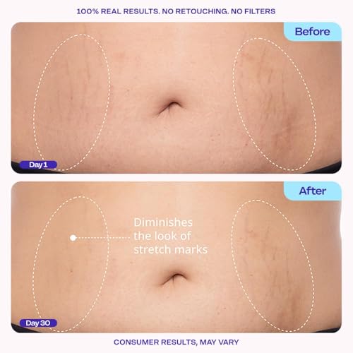GOPURE Tighten & Smooth Belly Cream - Clinically Tested with MicroTight4 Complex to Reduce the Appearance of Cellulite & Stretch Marks - Quick Absorbing for Smoother, Firmer-Looking Skin, 4.25oz - Image 6
