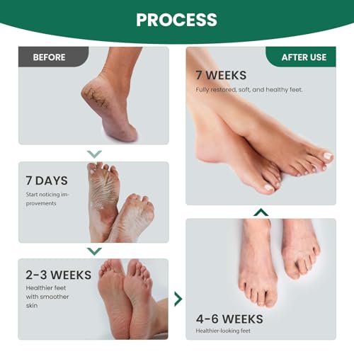 7 Days Ginger Foot Spray - Odor Control & Callus Care, Natural Ginger Nail Treatment - Refreshing & Nourishing Formula, Plant-Based Care for Feet, 20ml (1 WEEKS, Original) - Image 5
