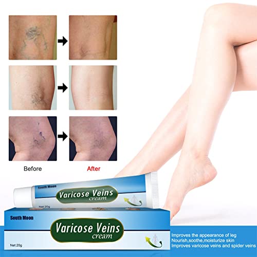 RUMUI Crema Trattamento Vene Varicose,Vene