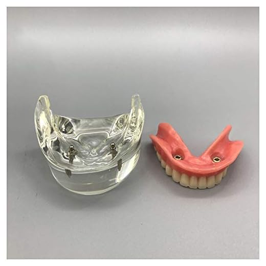 WJH Modelo Dental - Implantes Dentales - sobredentadura mandibular Inferior 2 Implantes Demo para la enseñanza y estudiar