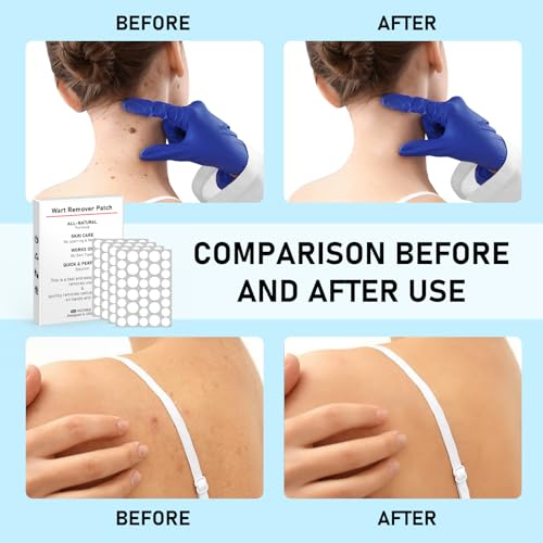 WABRINY Wart Remover Patches, Fast & Easy Operate Hydrocolloid Gel Waterproof Invisible Sticker, Skin Care Removal Patches for All Skin Types(144pcs)-R1 - Thumbnail 7