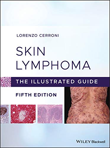Skin Lymphoma: The Illustrated Guide Skin Lymphoma: The Illustrated Guide