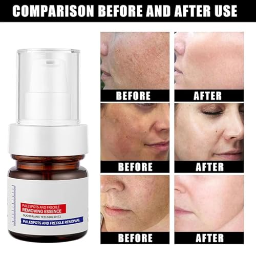 Generic Aobenz Spot Remover For Face,𝐖𝐡𝐢𝐭𝐞𝐧𝐢𝐧𝐠 And 𝐅𝐫𝐞𝐜𝐤𝐥𝐞 Removing Essence,𝐀𝐧𝐭𝐢-𝐬𝐩𝐨𝐭 Serum,Korean Vitamin C Serum Face Cream For Women thumb #1