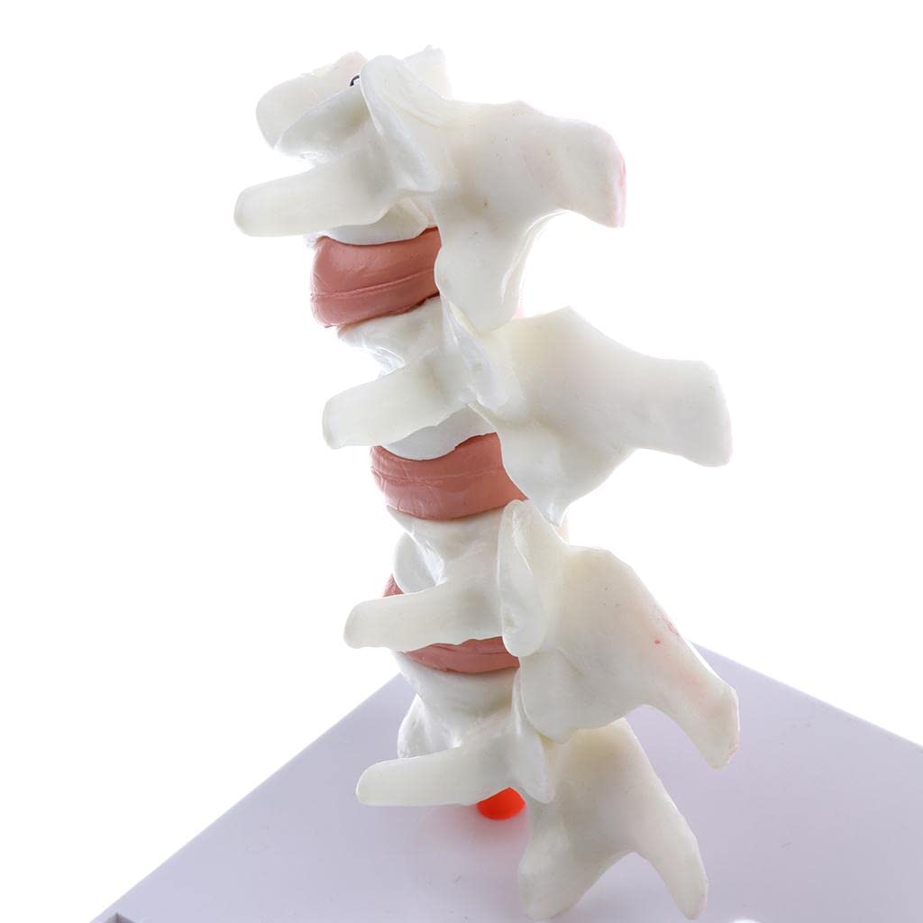 predolo 1: 1 Modellbausatz für Die Osteoporose des Menschlichen