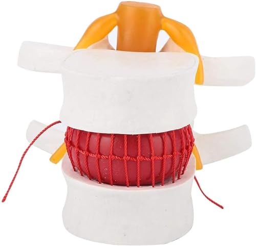Modèle de hernie discale lombaire pour illustrer la compression