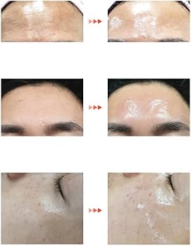 【最新版】『ララピール１箱ベーシック▪︎ウルトラ各1本韓国No1 楽天市場】ララピール シミ ニキビ セルフで ダウンタイムなし