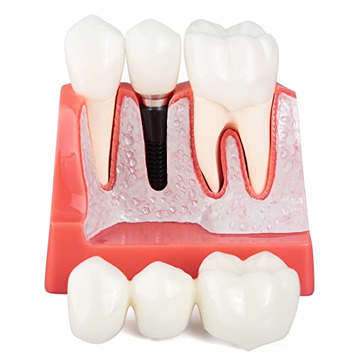 Dental Implant Model - 4 Times Crown Bridge Explanation Model Implant Analysis Tooth Model Removable Crown Cross-Section Demonstration for Study and Teaching