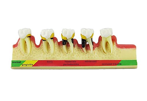 La maladie parodontale dentaire prématurée associe le modèle pédagogique des études sur les dents de dents Typodont
