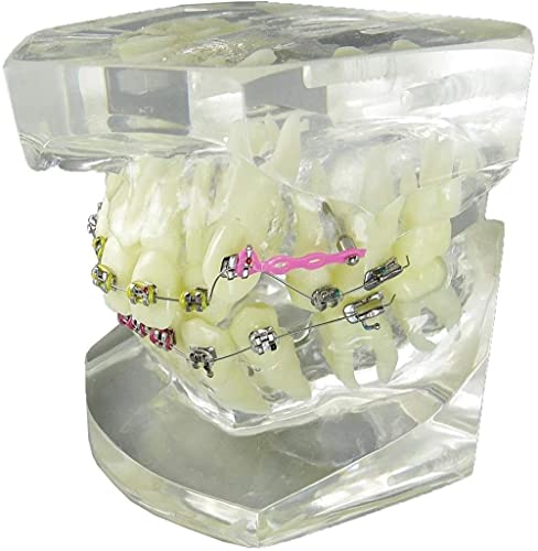 Modèle dentaire malocclusion pour expliquer le traitement aux patients