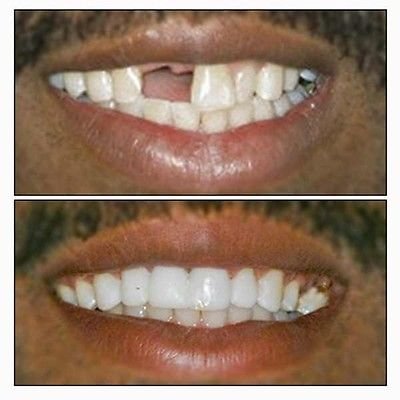 TEMPORARY TOOTH diy kit for 25-30 cosmetic TEMP TEETH. REPLACE MISSING TOOTH