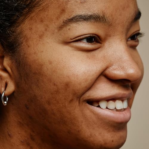 Ep 01: El Estigma Social del Acn&eacute;