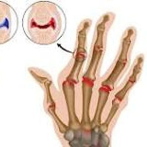 Comentario m&eacute;dico: La artritis