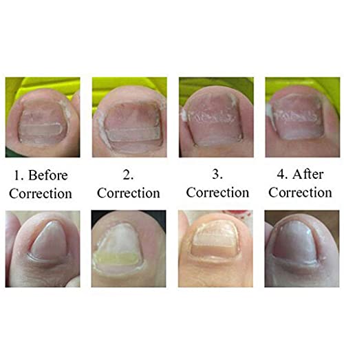 Sollevamento delle Unghie dei Piedi Incarnite +