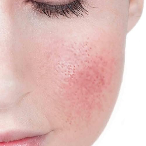 LAS PIELES SENSIBLES EN OTO&Ntilde;O, con Dra. Helga Rivera