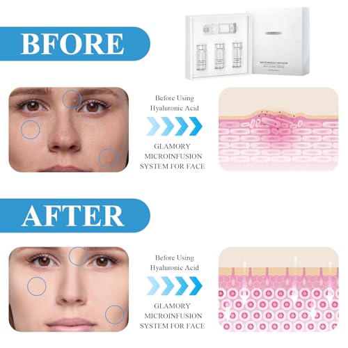 Micro Infusion System,Micro Infusionssystem für Lippen,Gesichtssystem mit Serum,Sanft und Hautfreundlich,Tief Feuchtigkeitsspendend,Einfach zu Bedienen,für Eine Vielzahl von Hauttypen Geeignet