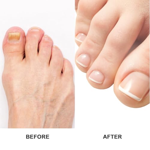 Bienengift Nagelserum, Furzero Bienengift Nagel, Furzero Bienengift Nagelserum, Furzero Nagelverteidigung Bienengift, Nagelwachstums- und Reparaturserum für Reparatur und Nagelwachstum