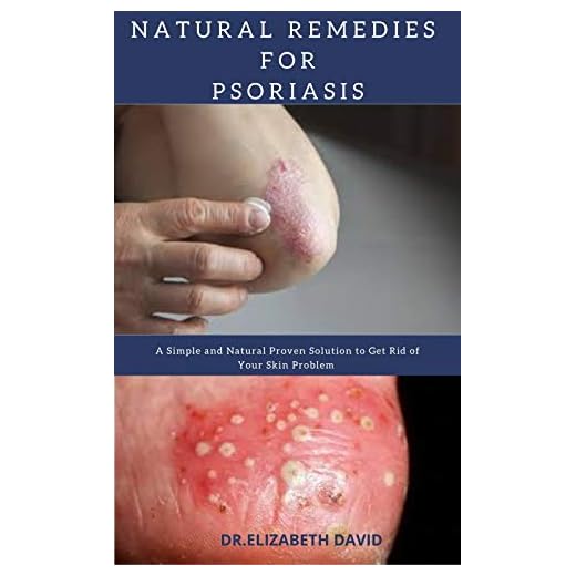 NATURAL REMEDIES FOR PSORIASIS: A Simple and Natural Proven Solution to Get Rid of Your Skin Problem : Dermatitis, Eczema, Psoriasis & Rosacea and Others