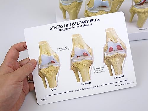 GPI Anatomicals 1100 Osteo-Kniemodellset 4 verschiedener Stadien